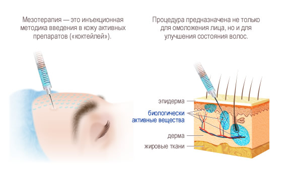 mezoterapia.jpg mezoterapia.jpg
